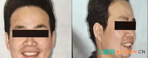 拍不好口腔照片怎么辦？這些口腔攝影方法與技巧請收好！